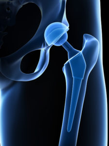 hip-implant